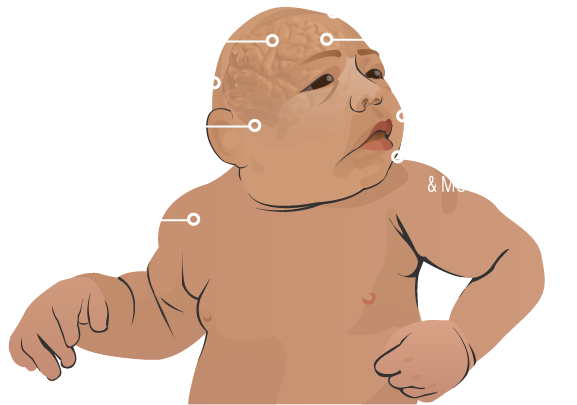 seizures,small head size, coordination difficulties, dwarfism/short stature, backward-sloping forehead, hyperactivity, facial distortions, delays in speech and movement