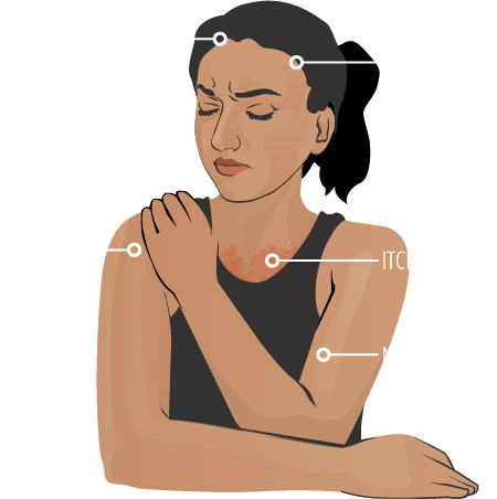 headache, fever, painful or red eyes, joint pain, itching/rash, muscle pain