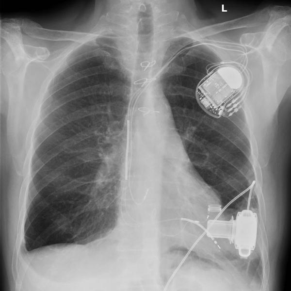 Artificial organs